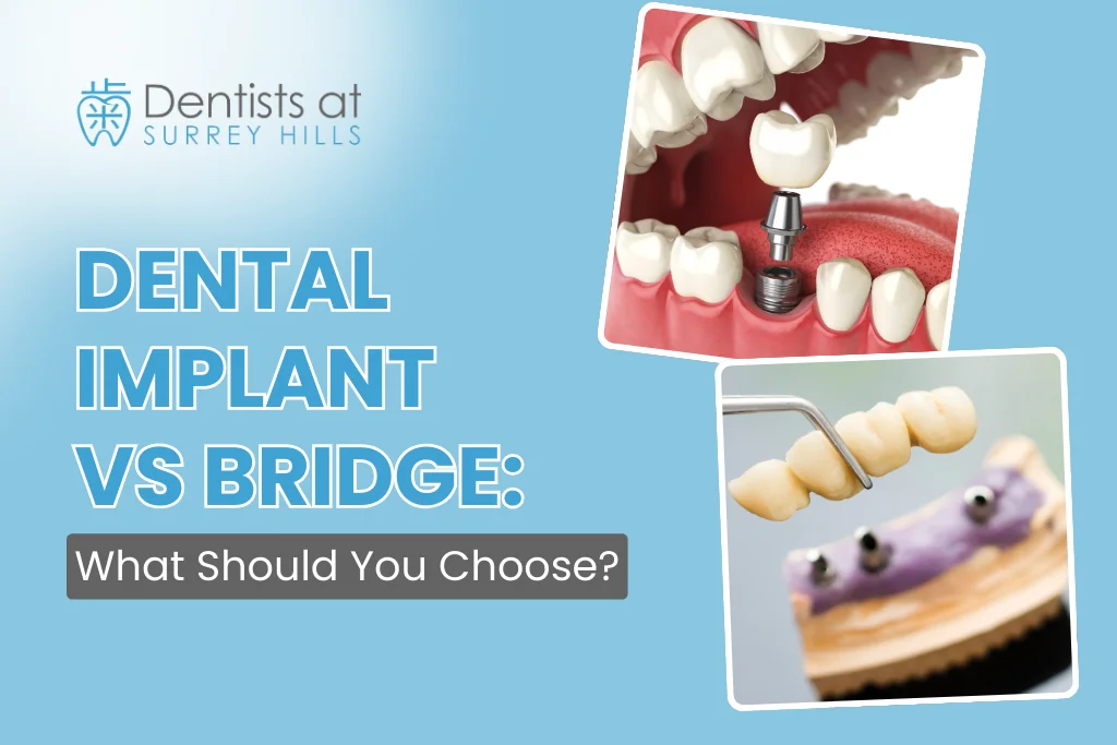 Dental Implants vs Dental Bridge