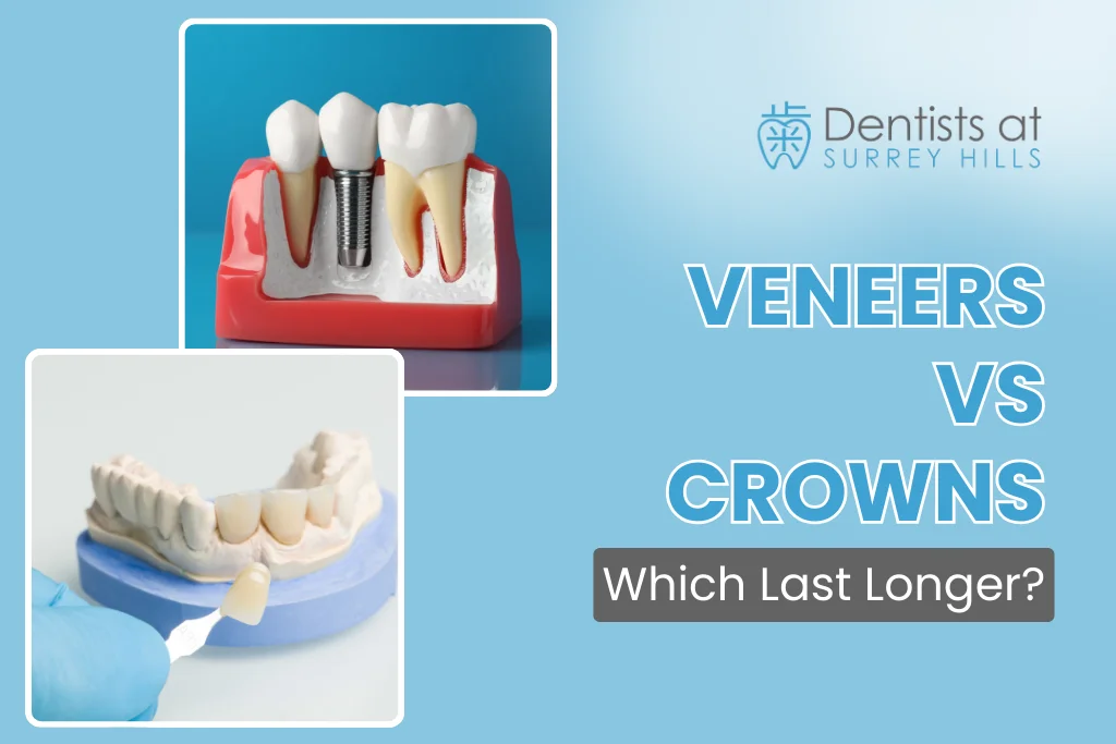 Veneers vs Crowns: Which Last Longer?
